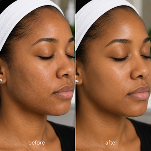 Dermaplaning