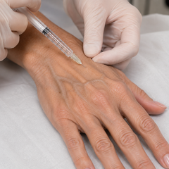 Hand Rejuvenation Filler