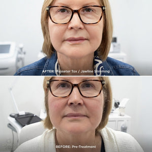 Masseter Reduction, Jaw Slimming & Teeth-Grinding Treatment
