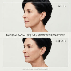 Bio Filler Natural Facial Rejuvenation PGEL With PRP or PRF