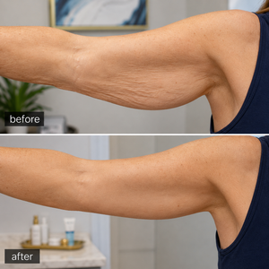 Renuva® Natural Volume Restoration