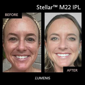 IPL Photofacial