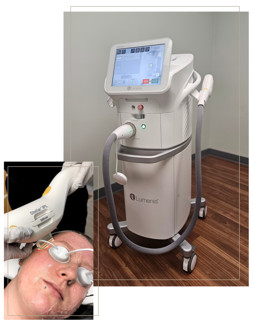 IPL Photofacial treatment using Lumenis Stellar M22 system