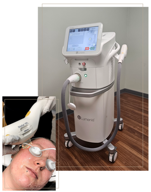 IPL Photofacial