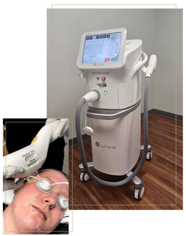 IPL Photofacial