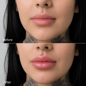 Lip Filler