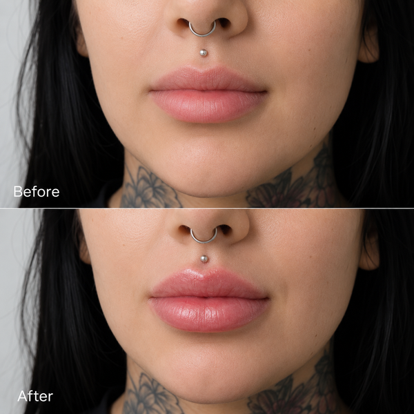 Lip Filler