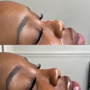 Non-Surgical Rhinoplasty