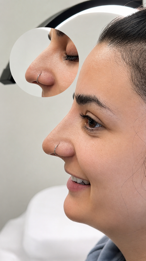 Non-Surgical Rhinoplasty